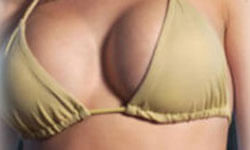 Picture of a woman, happy with her breast lift with implants procedure she had with Top Plastic Surgeons in beautiful Cabo San Lucas, Mexico.  The woman is facing the camera and wearing a mustard yellow bikini top.